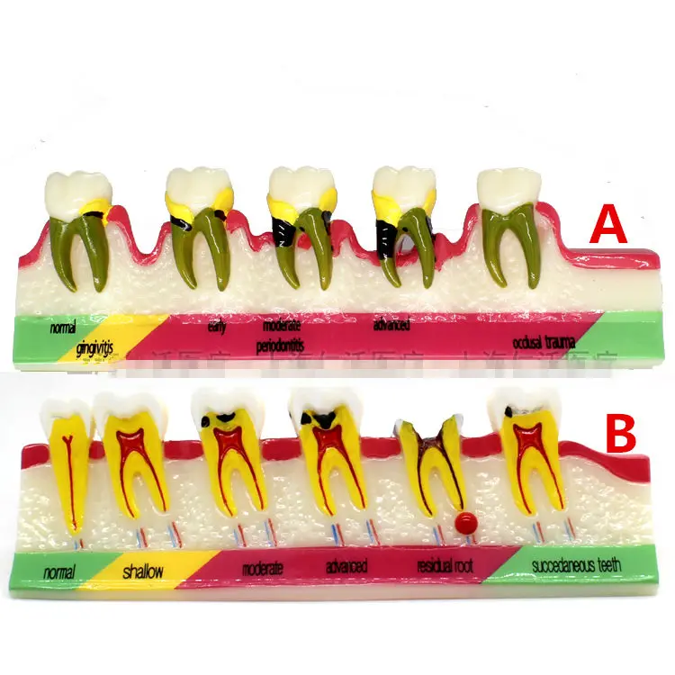 Стоматологическая модель, периодонтальное заболевание, Assort Tooth, типографский метод обучения, модель 2 типа на выбор
Стоматологическая модель, периодонтальное заболевание, Assort Tooth, типографский метод обучения, модель 2 типа на выбор