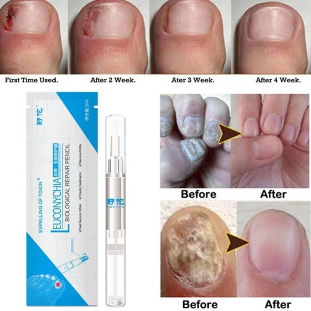 3ml Nail Fungal Treatment Pen Anti Fungus Infection Biological Repair Solution Nutritious Oil Fingernails Toenails Care | Красота и