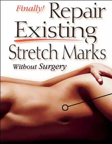 NEW Deluxe Stretch Mark Treatment Kit Fastest Way to Remove or Reduce them NOW FREE SHIPPING
NEW Deluxe Stretch Mark Treatment Kit Fastest Way to Remove or Reduce them NOW FREE SHIPPING