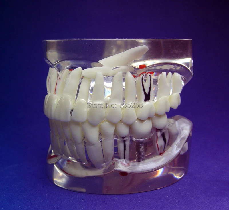 Transparent 1:1 Adult Teeth Pathology Model,Adult Tooth Pathological Planting Practice Model
Transparent 1:1 Adult Teeth Pathology Model,Adult Tooth Pathological Planting Practice Model