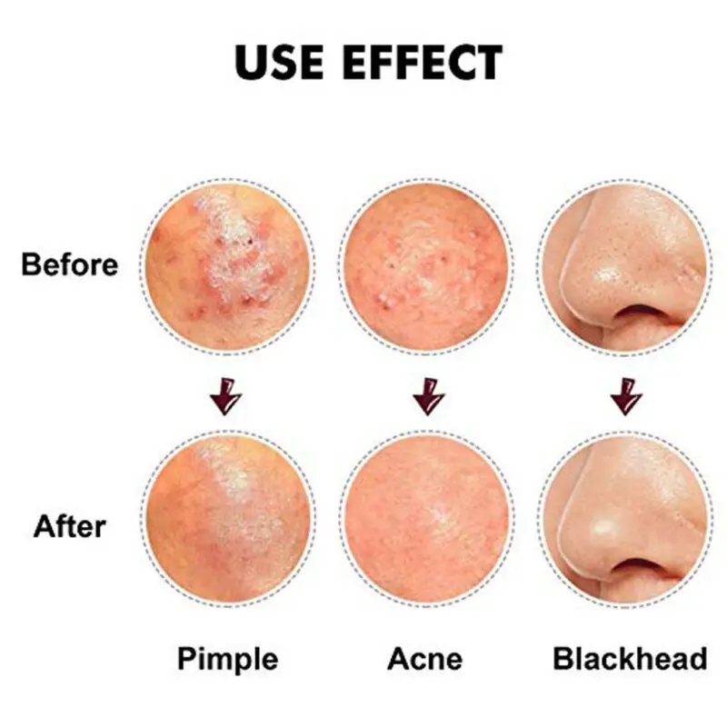5pcs Blackhead Pimple Blemish Comedone Acne needle Extractor Remover Tool Set Acne Removal Needle Beauty Tool Sets