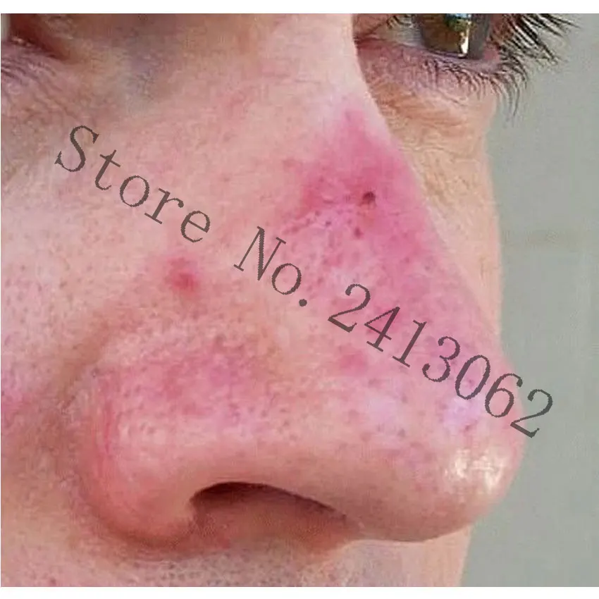 Pearl Acne Cream Red Nose Ointment Blackhead Remove Acne Cream Skin Care Herbal Anti Acne Mite Acne Rosacea Treat Shrink Pores
Pearl Acne Cream Red Nose Ointment Blackhead Remove Acne Cream Skin Care Herbal Anti Acne Mite Acne Rosacea Treat Shrink Pores