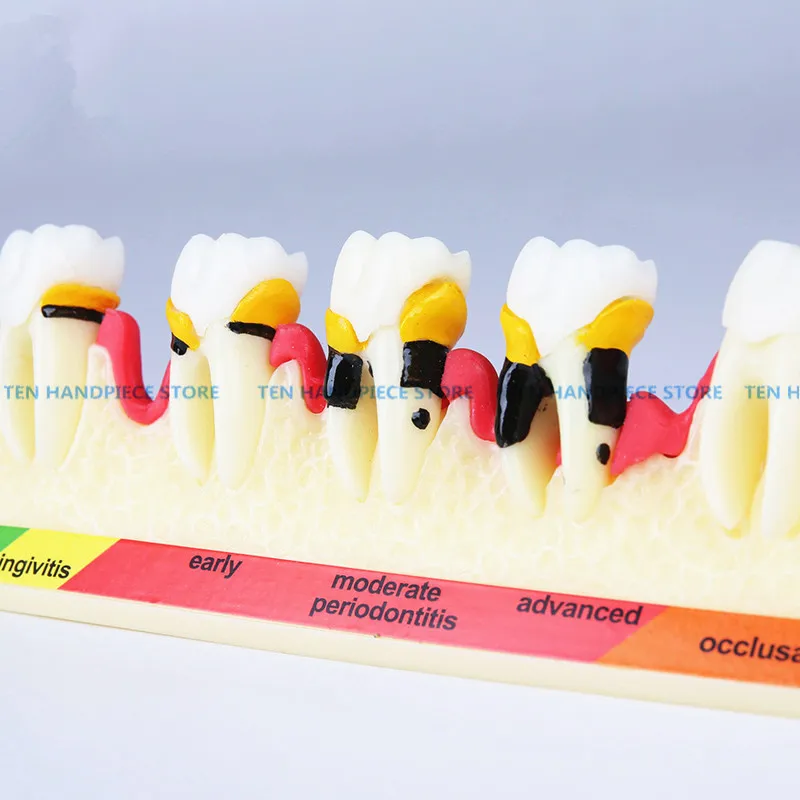 2018 new Classification of periodontal diseases teeth model Dental patient communication model process of periodontal disease
2018 new Classification of periodontal diseases teeth model Dental patient communication model process of periodontal disease