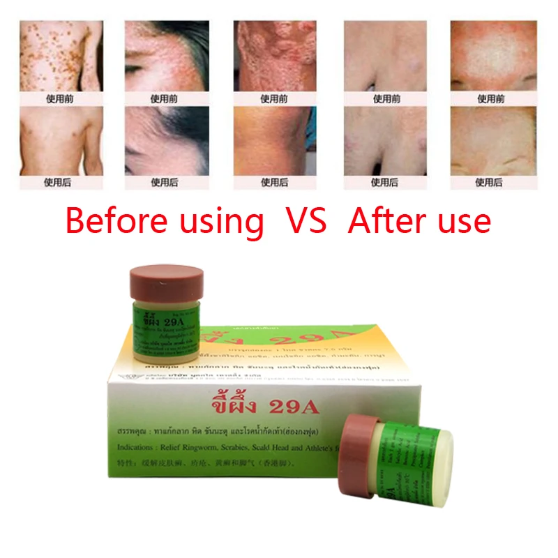 Натуральная мазь Psoriasi Eczma из Таиланда, 29A, крем отлично работает при дерматите псориаз экзема, уртрия, Прямая поставка, 1 шт.
Натуральная мазь Psoriasi Eczma из Таиланда, 29A, крем отлично работает при дерматите псориаз экзема, уртрия, Прямая поставка, 1 шт.
