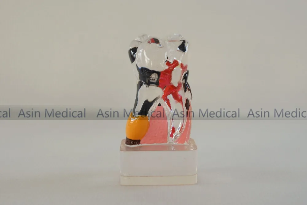 High Quality Dental Teeth Model 4 Times Periodontal Disease Assort Tooth Classification Model