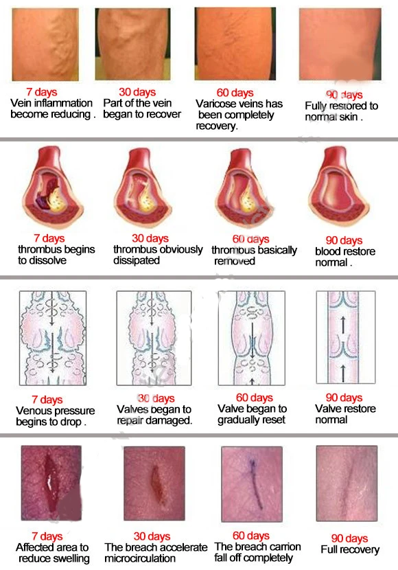 4Pcs Varicose Veins ointment vasculitis treatment Phlebitis Angiitis inflammation blood vessel Rotten legs Varicose Veins Cream
4Pcs Varicose Veins ointment vasculitis treatment Phlebitis Angiitis inflammation blood vessel Rotten legs Varicose Veins Cream