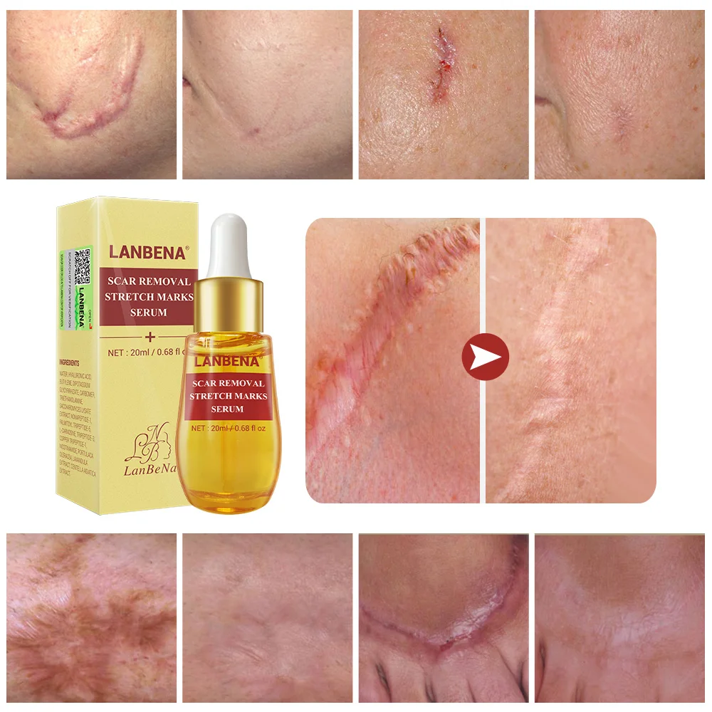 LANBENA Scar Acne Remover Serum Remove Stretch Marks Fade Scar Acne Treatment Pockmark Burn Surgical Scar Facial Skin Care
LANBENA Scar Acne Remover Serum Remove Stretch Marks Fade Scar Acne Treatment Pockmark Burn Surgical Scar Facial Skin Care