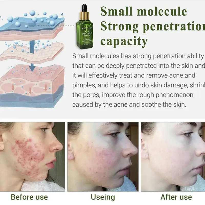 BREYLEE Acne Treatment Face Serum Skin Care Whitening Repair Pimple Remover For Acne Serum Anti Acne Scar Removal Cream
BREYLEE Acne Treatment Face Serum Skin Care Whitening Repair Pimple Remover For Acne Serum Anti Acne Scar Removal Cream