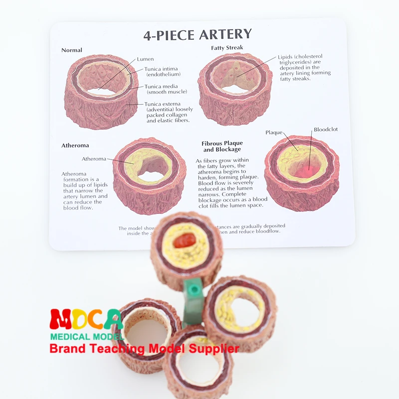 Vessel anatomy, atherosclerosis, pathology, cardiovascular circulation model medicine teaching MXG001
Vessel anatomy, atherosclerosis, pathology, cardiovascular circulation model medicine teaching MXG001