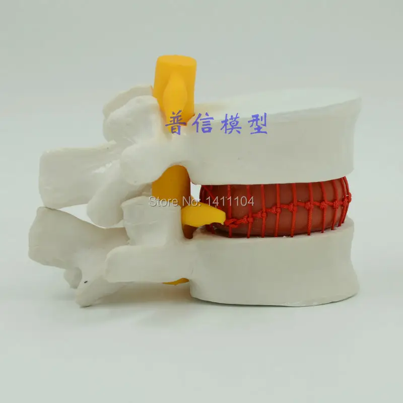 Free shipping&Large lumbar spine blood cell model, lumbar disc herniation demonstration,human spinal medical model
Free shipping&Large lumbar spine blood cell model, lumbar disc herniation demonstration,human spinal medical model