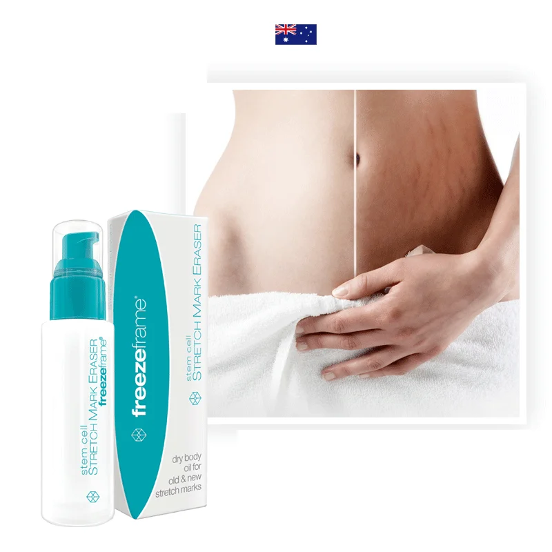 Original Freezeframe Stem Cell Treatment of Stubborn Old New STRETCH MARK ERASER Body Solutions Massage Cream for Smoother Skin
Original Freezeframe Stem Cell Treatment of Stubborn Old New STRETCH MARK ERASER Body Solutions Massage Cream for Smoother Skin