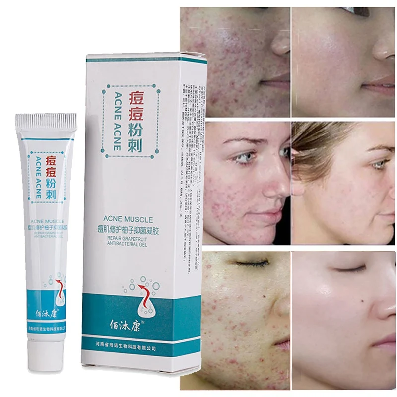 Acne Treatment Blackhead Remova Cream Anti Acne Cream Oil Control Acne Scar Remove Shrink Pores Removal Face Care Whitening
Acne Treatment Blackhead Remova Cream Anti Acne Cream Oil Control Acne Scar Remove Shrink Pores Removal Face Care Whitening