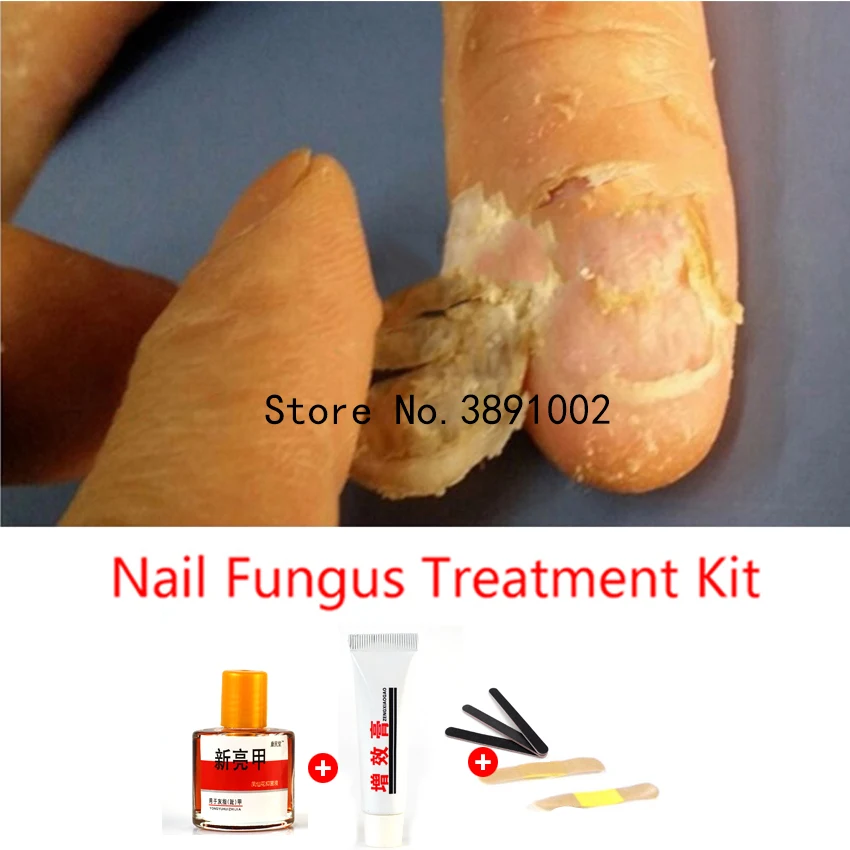 Herbal Fungal Nail Treatment Essence Toe Nail Finger Anti Fungus Infection Nail Treatment Removal Nail Care Lotion
Herbal Fungal Nail Treatment Essence Toe Nail Finger Anti Fungus Infection Nail Treatment Removal Nail Care Lotion