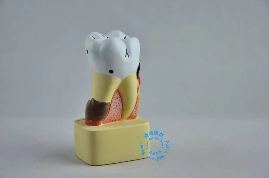 Free shipping teaching model&Tooth disease pathological anatomical model of teeth caries gingival medical wholesale
Free shipping teaching model&Tooth disease pathological anatomical model of teeth caries gingival medical wholesale