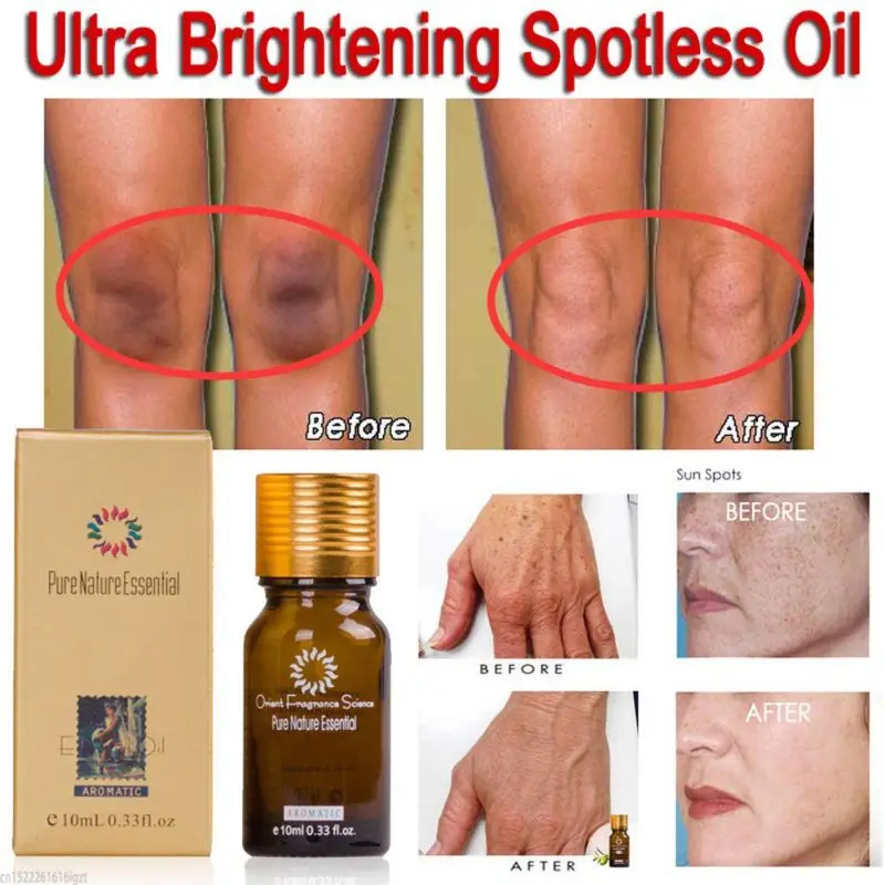 2021 Natural Essence Skin Care New Pure Remove Strentch Marks Scar Removal Ultra Spotless Brightening Oil Lavender
2021 Natural Essence Skin Care New Pure Remove Strentch Marks Scar Removal Ultra Spotless Brightening Oil Lavender