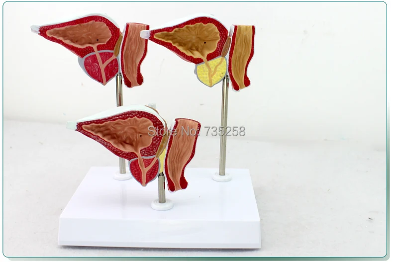 Normal And Pathological Changes Of Prostate Demonstration Model,Model of Prostatic Adenocarcinoma
Normal And Pathological Changes Of Prostate Demonstration Model,Model of Prostatic Adenocarcinoma