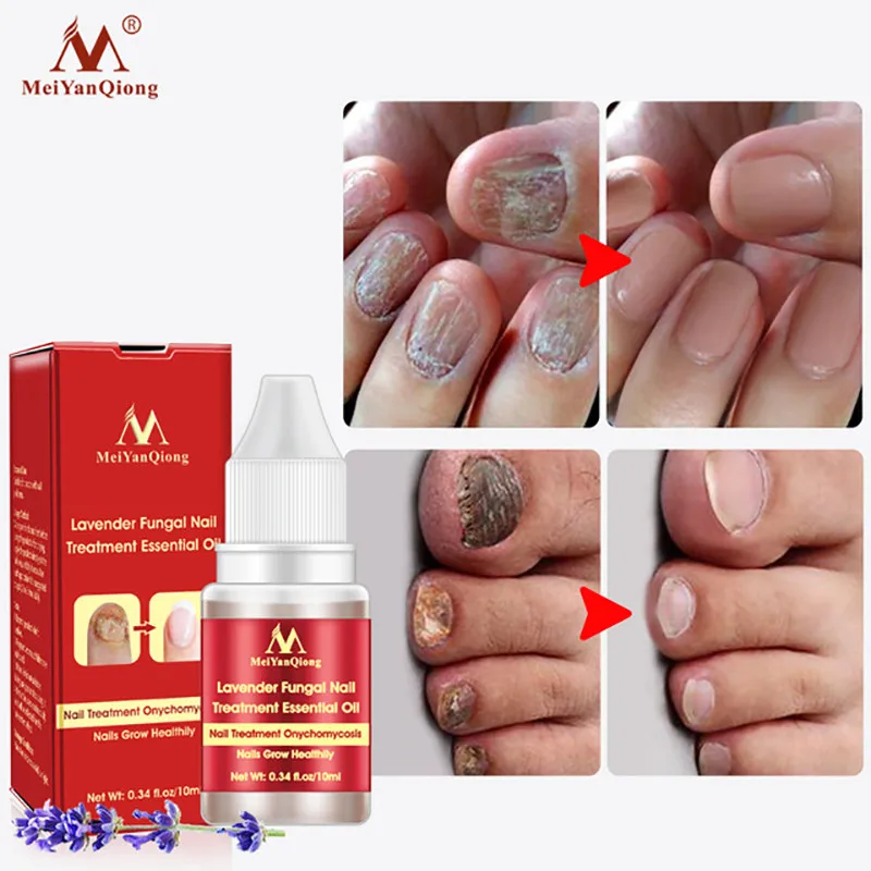 MeiYanQiong Lavender Nail Treatment Essential Oil Promote Nails Grow Healthy Nail Treatment Fungus Removal Foot Care 10ml
MeiYanQiong Lavender Nail Treatment Essential Oil Promote Nails Grow Healthy Nail Treatment Fungus Removal Foot Care 10ml