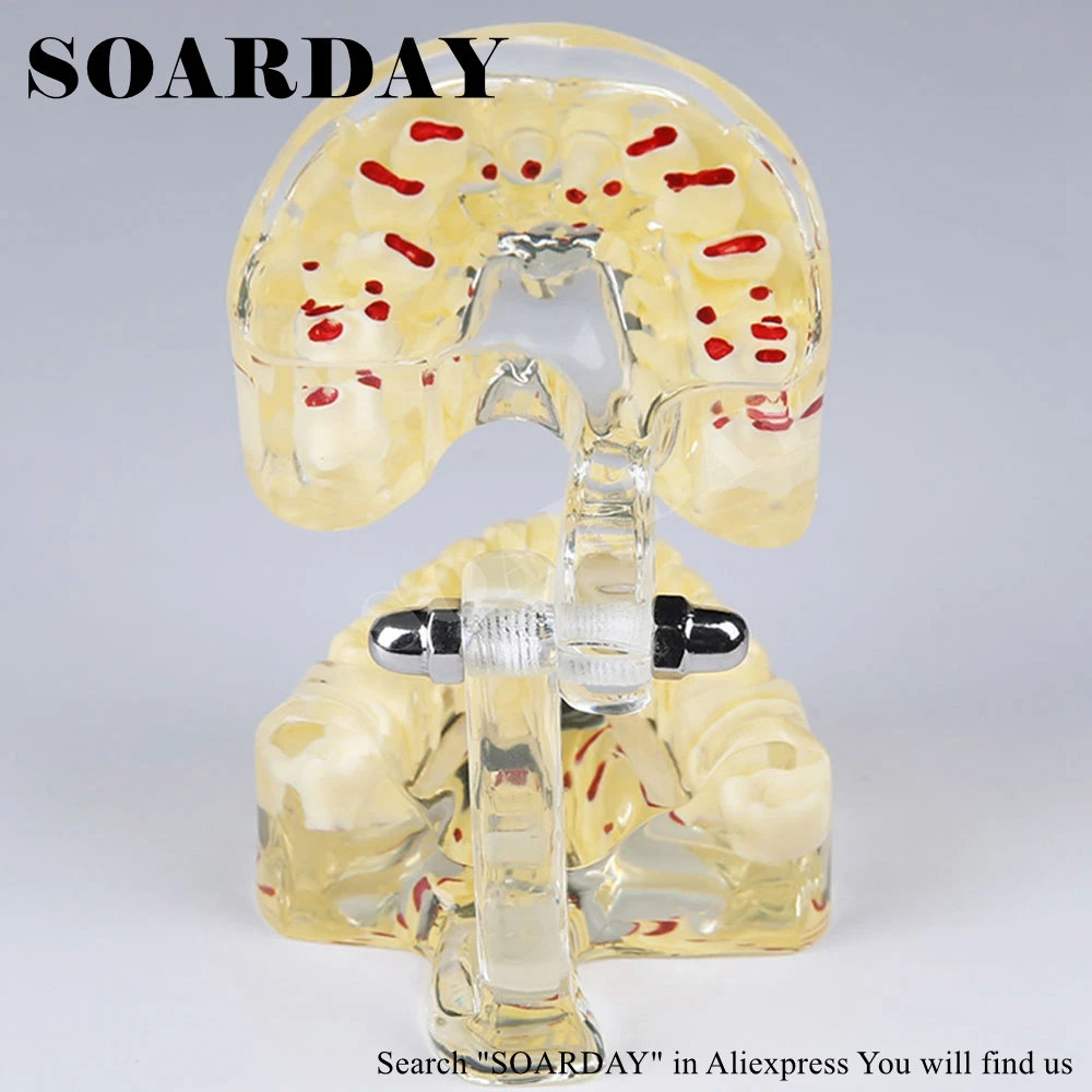 SOARDAY Children Primary Teeth Alternating Transparent Model Dental Root Clearly Displayed Dentist Patient Communication
SOARDAY Children Primary Teeth Alternating Transparent Model Dental Root Clearly Displayed Dentist Patient Communication