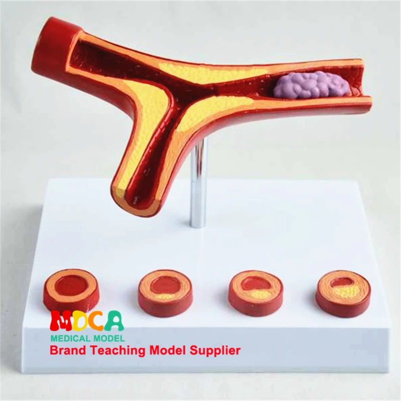 MXG002 Teaching of Anatomical Surface Model Medicine in Arteriosclerosis Model with Thrombotic Coronary Heart Disease
MXG002 Teaching of Anatomical Surface Model Medicine in Arteriosclerosis Model with Thrombotic Coronary Heart Disease