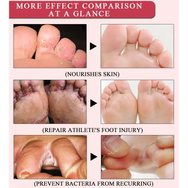 Anti Fungal Infection Foot Repair Cream Foot Cream Herbal Anti Fungal Relieve Beriberi Cream Foot Care Treatment Skin Care
Anti Fungal Infection Foot Repair Cream Foot Cream Herbal Anti Fungal Relieve Beriberi Cream Foot Care Treatment Skin Care