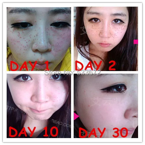 Orignal Chinese Medication Speckle Freckle Moles Wart Remove Water Speckle Freckle Seamless Water Drops Skin Tags Removal Cream
Orignal Chinese Medication Speckle Freckle Moles Wart Remove Water Speckle Freckle Seamless Water Drops Skin Tags Removal Cream