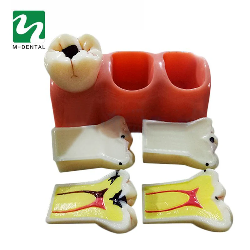 1 pc Dental Materials Lab 4 Times Caries Disassembling Model Denture Disease Teeth Model For Dentist Clinic
1 pc Dental Materials Lab 4 Times Caries Disassembling Model Denture Disease Teeth Model For Dentist Clinic