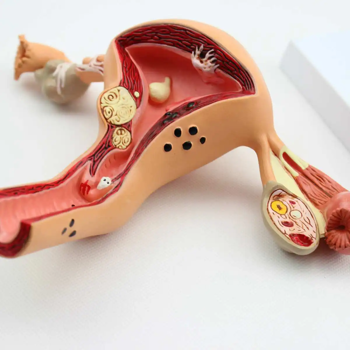 Uterus Ovary Anatomical Model Common Pathologies Uterine Disease Ovarian Disease Ovarian Obstetrics Gynecology Teaching Mould
Uterus Ovary Anatomical Model Common Pathologies Uterine Disease Ovarian Disease Ovarian Obstetrics Gynecology Teaching Mould