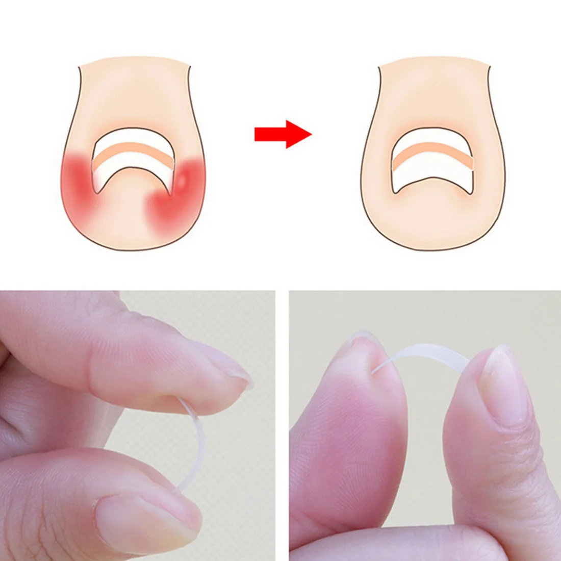 10 шт. инструмент для коррекции вросших ногтей лечения эластичная наклейка зажим