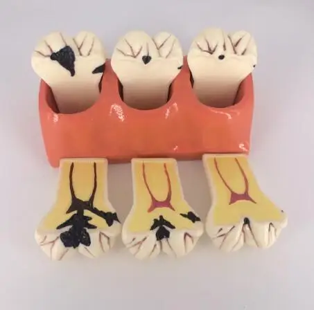 4Xdecayed tooth Decomposition Models Doctor-patient communication model 7 parts free shipping
4Xdecayed tooth Decomposition Models Doctor-patient communication model 7 parts free shipping