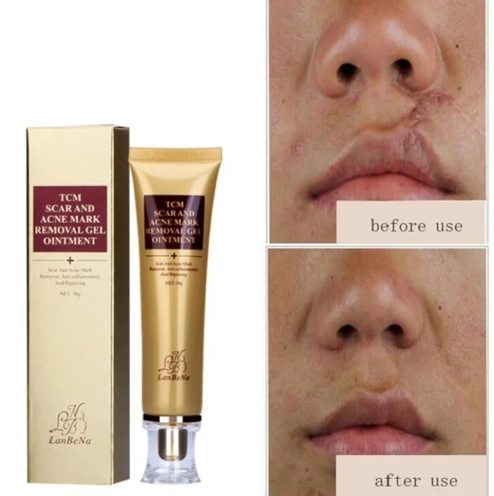 Stretch Marks Acne Scar Remover Cream Ginseng Serum Acne Treatment Shrink Pores Gel Face Care Tool Bleaching Whitening Cream
Stretch Marks Acne Scar Remover Cream Ginseng Serum Acne Treatment Shrink Pores Gel Face Care Tool Bleaching Whitening Cream