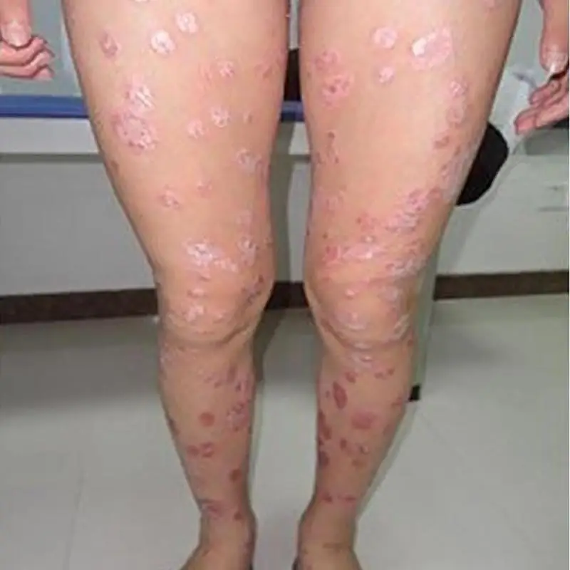 Herbal Natural Body Herbal Material Psoriasis Creams and Eczema Psoriasis Ointment Skin Care Health Products Patches
Herbal Natural Body Herbal Material Psoriasis Creams and Eczema Psoriasis Ointment Skin Care Health Products Patches