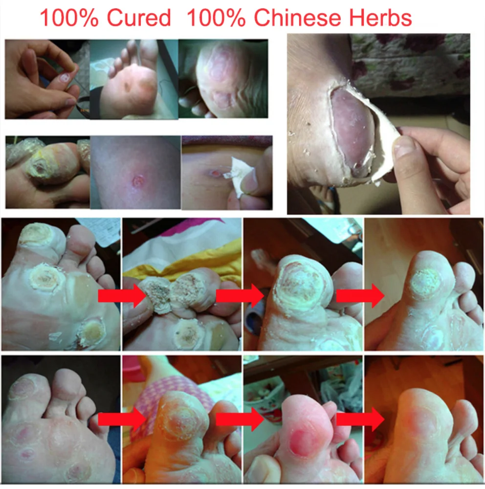 Chinese Medicine Treatment Foot Corn Removal Plantar warts Pomada De Verruga Foot Care Medical Plaster Ointment Warts Removal
Chinese Medicine Treatment Foot Corn Removal Plantar warts Pomada De Verruga Foot Care Medical Plaster Ointment Warts Removal