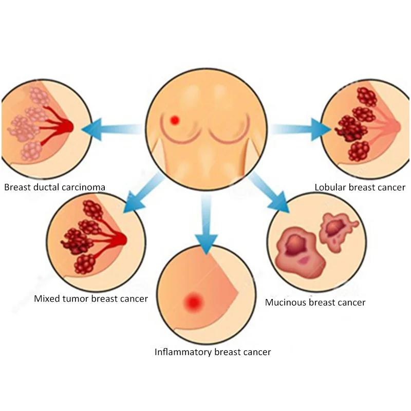 50 Pcs Chronic Mastitis Breast Care Plaster Mammary Glands Swelling Pain Relief Breast Lump Anti Breast Hyperplasia Massage
50 Pcs Chronic Mastitis Breast Care Plaster Mammary Glands Swelling Pain Relief Breast Lump Anti Breast Hyperplasia Massage