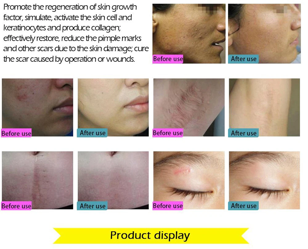 Face Care Essential Oil Acne Scar Spots Removal Skin Care Whitening Remove Scars Acne Repair Face Cream Essence Acne Treatment
Face Care Essential Oil Acne Scar Spots Removal Skin Care Whitening Remove Scars Acne Repair Face Cream Essence Acne Treatment