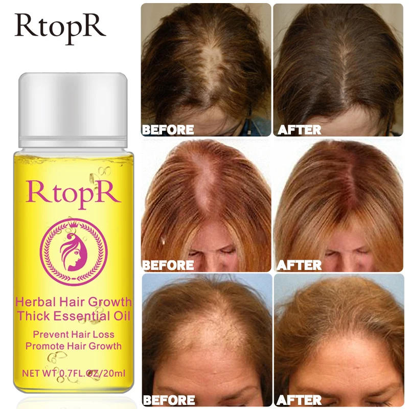 20ml Herbal Hair Growth Anti Hair Loss Liquid Promote Thick Fast Hair Growth Treatment Essential Oil Health Care Beauty Essence
20ml Herbal Hair Growth Anti Hair Loss Liquid Promote Thick Fast Hair Growth Treatment Essential Oil Health Care Beauty Essence