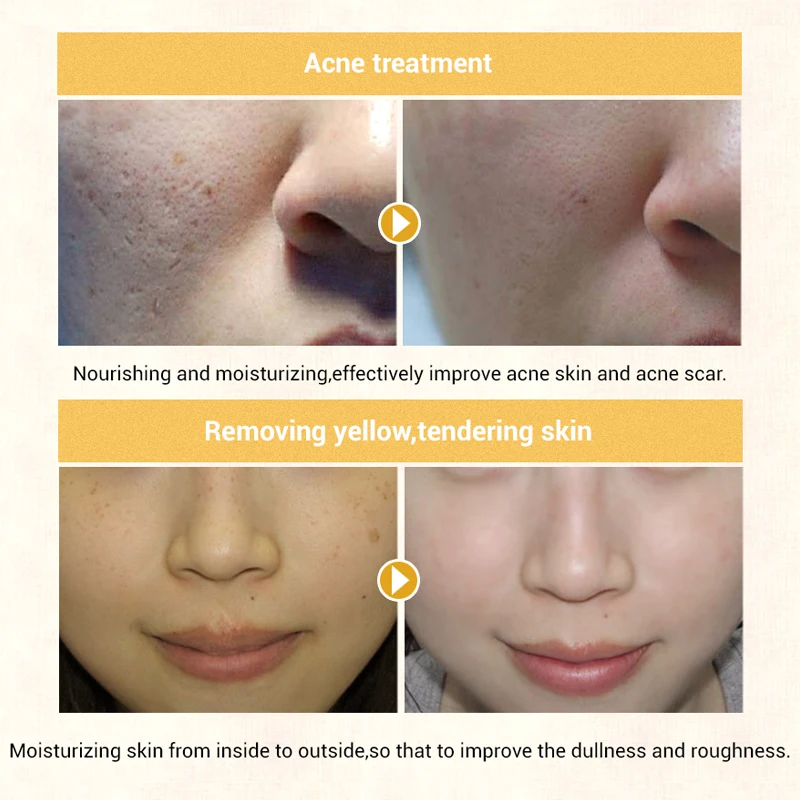 OMY LADY Anti aging collagen essence deep moisturizing facial serum hydra shrink pores whitening Hyaluronic acid 10ml
OMY LADY Anti aging collagen essence deep moisturizing facial serum hydra shrink pores whitening Hyaluronic acid 10ml