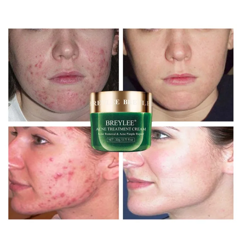 2019 Natural Acne Treatment Cream Anti Acne Face Cream Pimple Removal Spots Oil Control Shrink Pores Moisturizing Skin Care
2019 Natural Acne Treatment Cream Anti Acne Face Cream Pimple Removal Spots Oil Control Shrink Pores Moisturizing Skin Care