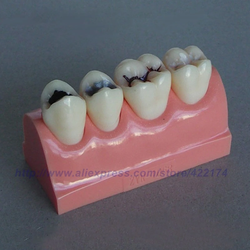Caries treatment model dental tooth teeth anatomical anatomy dentist model odontologia
Caries treatment model dental tooth teeth anatomical anatomy dentist model odontologia