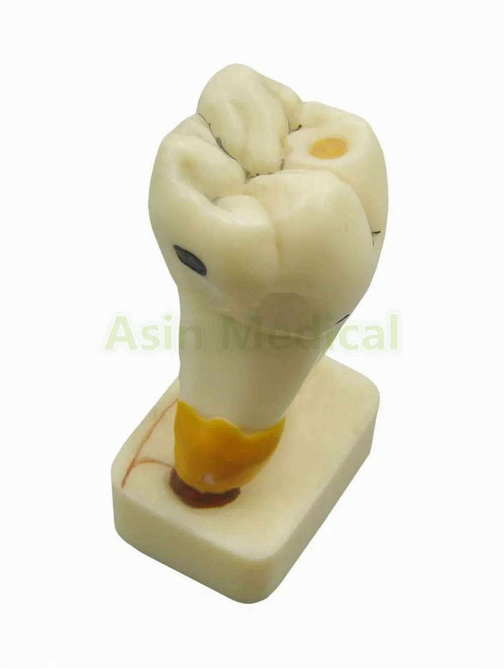 NEW Four times size dental pathology teeth model, dental caries, calculus, pulp stones, Occlusal tooth wear
NEW Four times size dental pathology teeth model, dental caries, calculus, pulp stones, Occlusal tooth wear