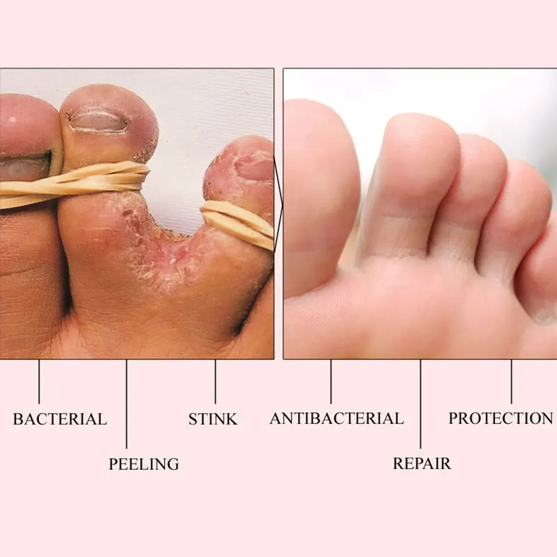 Herbal Effective Foot Cream Treatment Anti Fungal Infection Onychomycosis Paronychia Toe Fungus Gel Repair Dry Crack Feet Care
Herbal Effective Foot Cream Treatment Anti Fungal Infection Onychomycosis Paronychia Toe Fungus Gel Repair Dry Crack Feet Care