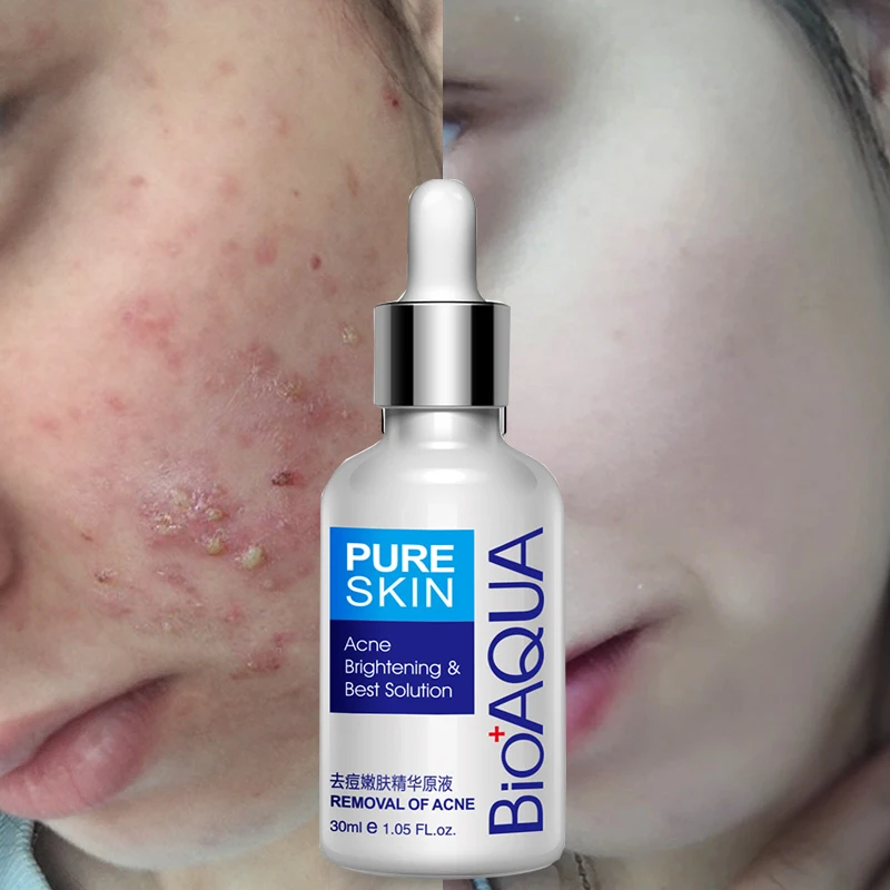 BIOAQUA Brand 30ml Acne Treatment Essence Acne Scar Removal Acne Spots Facial Skin Care Whitening Moisturizing Face Care
BIOAQUA Brand 30ml Acne Treatment Essence Acne Scar Removal Acne Spots Facial Skin Care Whitening Moisturizing Face Care