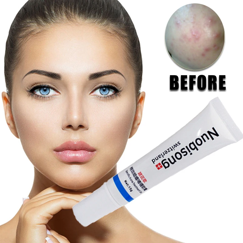 5pcs/lot NO BOX Nuobisong Specific Acne Treatment Gel, Face care effectively remove pimples without irritating
5pcs/lot NO BOX Nuobisong Specific Acne Treatment Gel, Face care effectively remove pimples without irritating