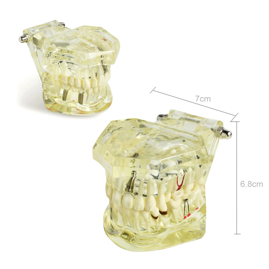 Dental Implant Disease Teeth Model with Restoration & Bridge Tooth for Medical Science Dental Disease Teaching Study
Dental Implant Disease Teeth Model with Restoration & Bridge Tooth for Medical Science Dental Disease Teaching Study