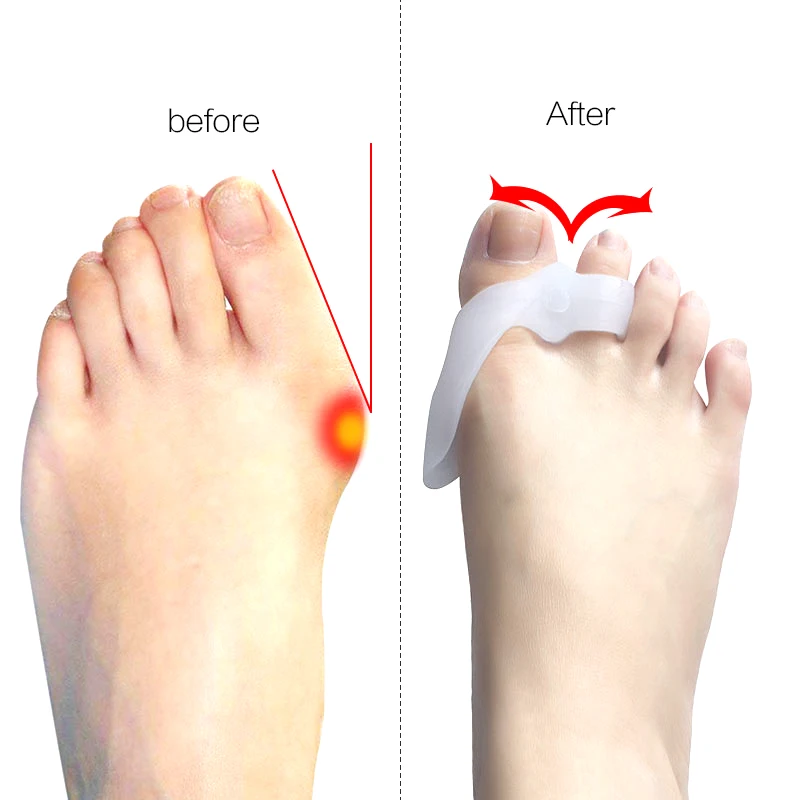 1Pair Bone Thumb Orthotics Silicone Bunion Corrector Toe Separators Foot Care Hallux Valgus Correction of The Thumb Adjuster-15
1Pair Bone Thumb Orthotics Silicone Bunion Corrector Toe Separators Foot Care Hallux Valgus Correction of The Thumb Adjuster-15