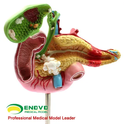 Pancreatic duodenal gallbladder pathological model gallstone surgical digestive system model 10*20*5.5cm
Pancreatic duodenal gallbladder pathological model gallstone surgical digestive system model 10*20*5.5cm
