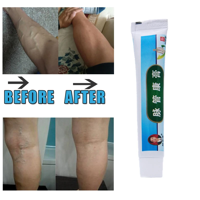 10pcs/lot Chinese natural herbal medicine for treating varicose vascular inflammation cream cure varicose vein ointment
10pcs/lot Chinese natural herbal medicine for treating varicose vascular inflammation cream cure varicose vein ointment