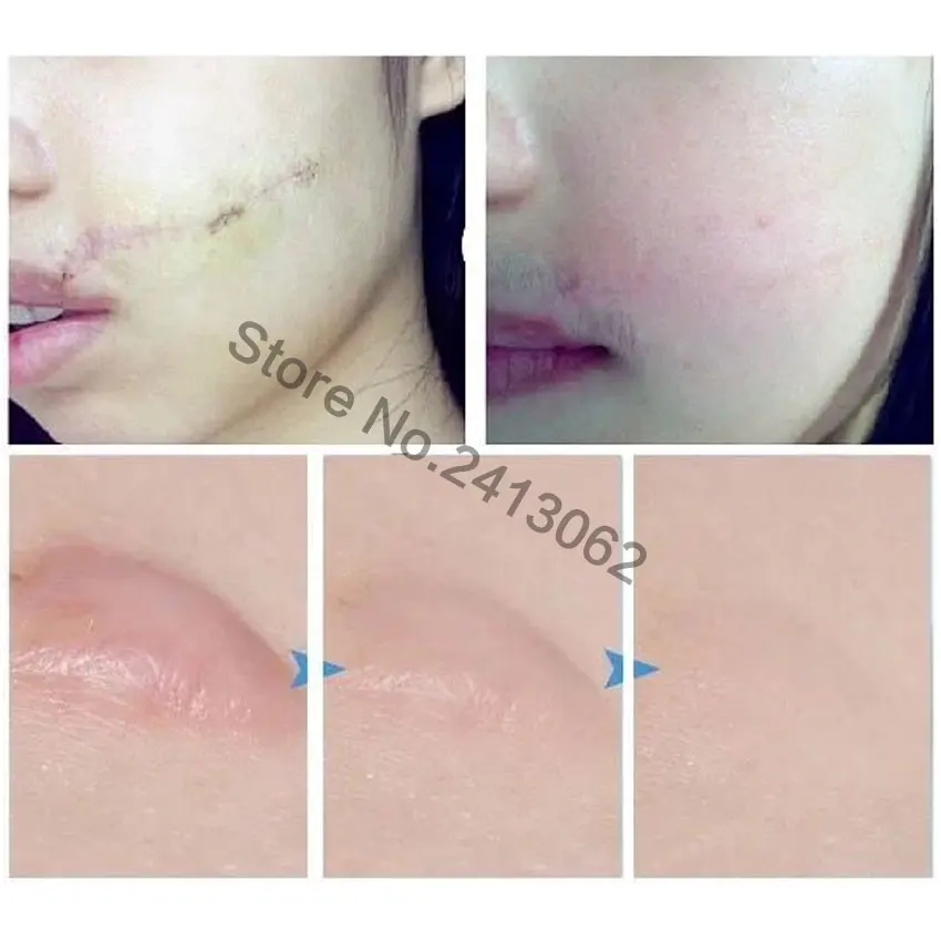 100% Natural Authentic Anti Acne Spots Essence Oil Scar Removal Remove Cream for Belly Stretch Mark Skin Whitening Moisturizing
100% Natural Authentic Anti Acne Spots Essence Oil Scar Removal Remove Cream for Belly Stretch Mark Skin Whitening Moisturizing