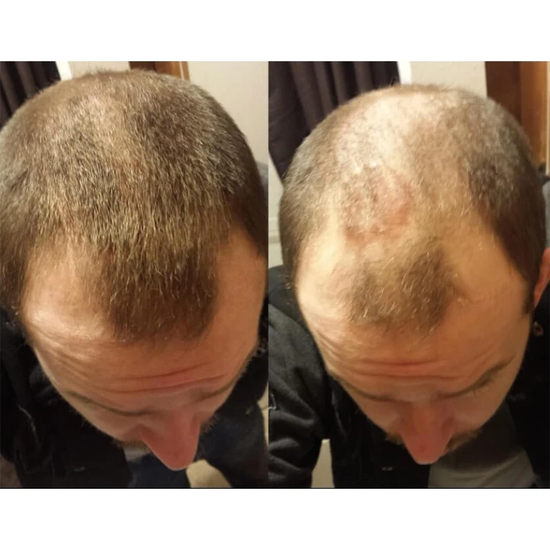 One kit 3pcs Hair Loss Product 2pcs Hair Care Fiber + 1pcs Hair Spray Pump Applicator Wig Thickening Hair Growth Keratin Fiber
One kit 3pcs Hair Loss Product 2pcs Hair Care Fiber + 1pcs Hair Spray Pump Applicator Wig Thickening Hair Growth Keratin Fiber