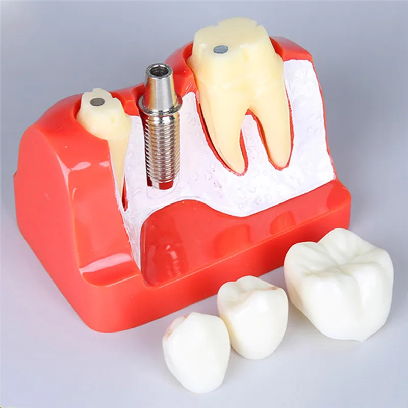 Фото 4 кратная модель для анализа зубных имплантов с восстановлением - купить