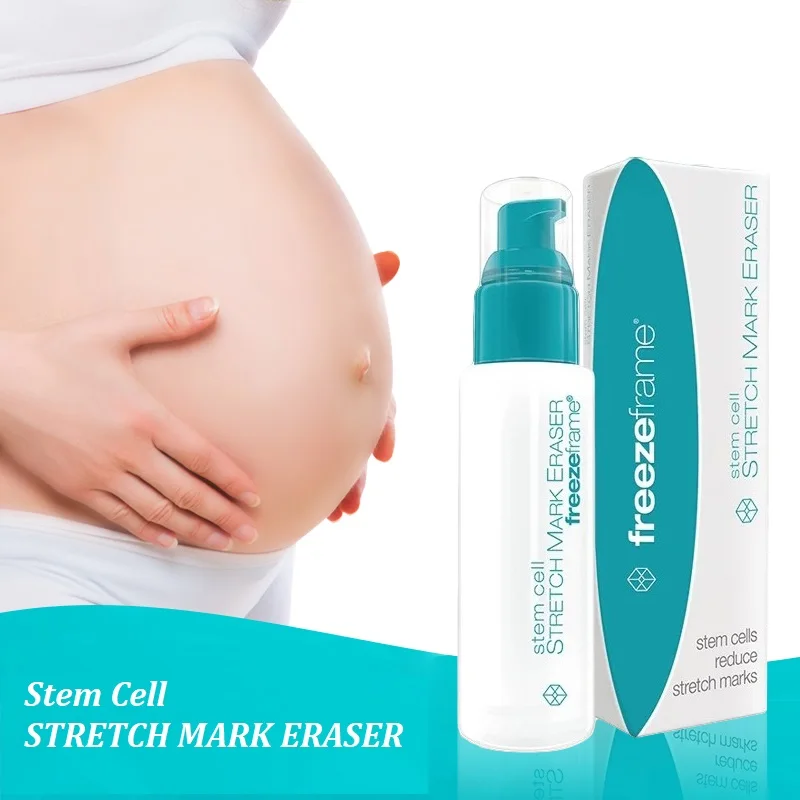 Australia Freezeframe Stem Cell Treatment for Stubborn Old New STRETCH MARK ERASER Damaged Skin Improve Elasticity Smooth Skin
Australia Freezeframe Stem Cell Treatment for Stubborn Old New STRETCH MARK ERASER Damaged Skin Improve Elasticity Smooth Skin